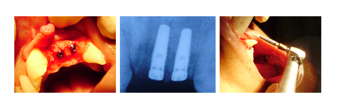 Dental Implants - 2